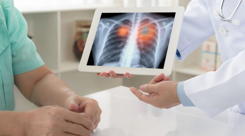 Estudos mostram eficácia de novos tratamentos para pacientes com tipo mais comum de câncer de pulmão