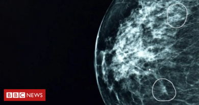 Câncer de mama: a ferramenta de IA capaz de detectar tumores que passaram desapercebidos por médicos