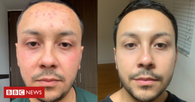 O que aprendi em minha desesperada busca por solução para acne severa