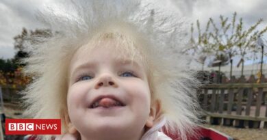 Síndrome do cabelo impenteável: 'O cabelo da minha filha é lindo'