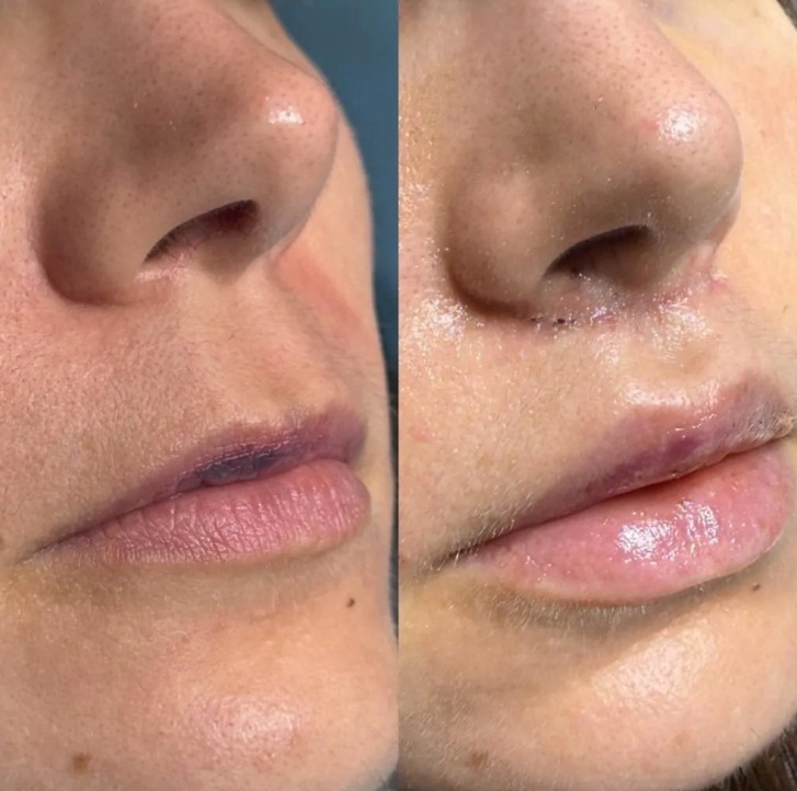 Resultados do Lip Lift após cerca de 10 dias