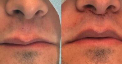 Lip Lift e técnicas avançadas de rejuvenescimento facial sem volume