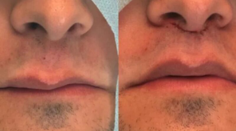 Lip Lift e técnicas avançadas de rejuvenescimento facial sem volume